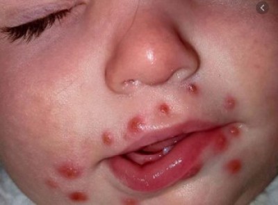 Tuyên truyền phòng chống bệnh tay chân miệng